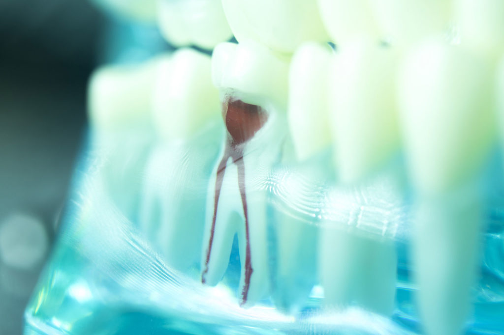 root_canal-03-edit