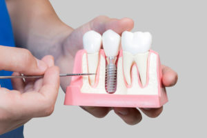Dental Assistant Showing Off A Dental Implant In A Jawbone Cutaway Model in Fort Worth, TX
