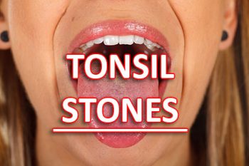 Fort Worth, TX dentist, Dr. Green at Fort Worth Cosmetic & Family Dentistry, tells patients about what causes tonsil stones and how to treat and prevent them from forming.
