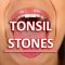 Suffering from a Sore Throat & Bad Breath? You Might Have Tonsil Stones (featured image)